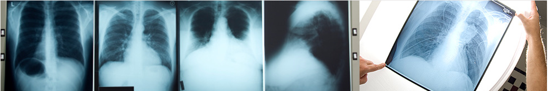 thoracic-featured-image